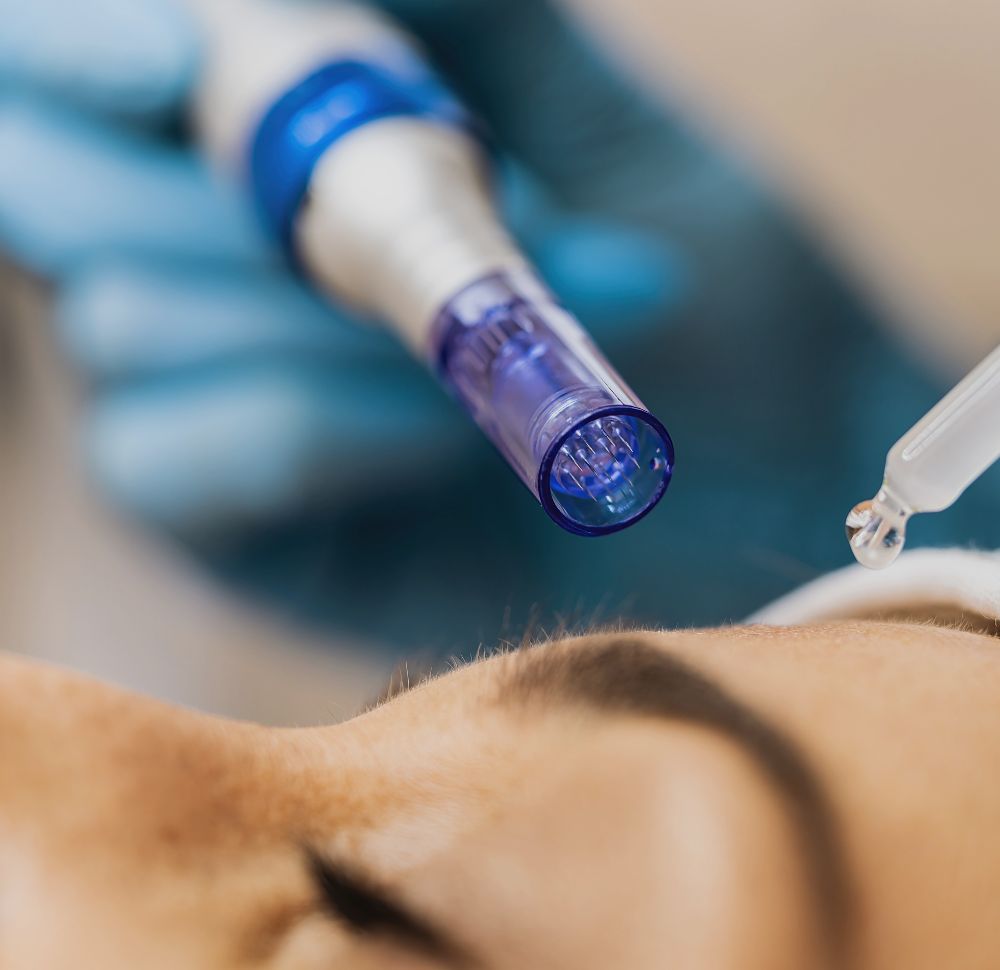 Entdecken Sie die Geheimnisse jugendlicher Haut mit Meso-Microneedling